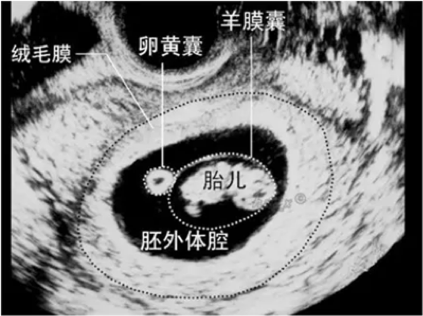 检测出怀孕后一定要去做B超吗? - 知乎