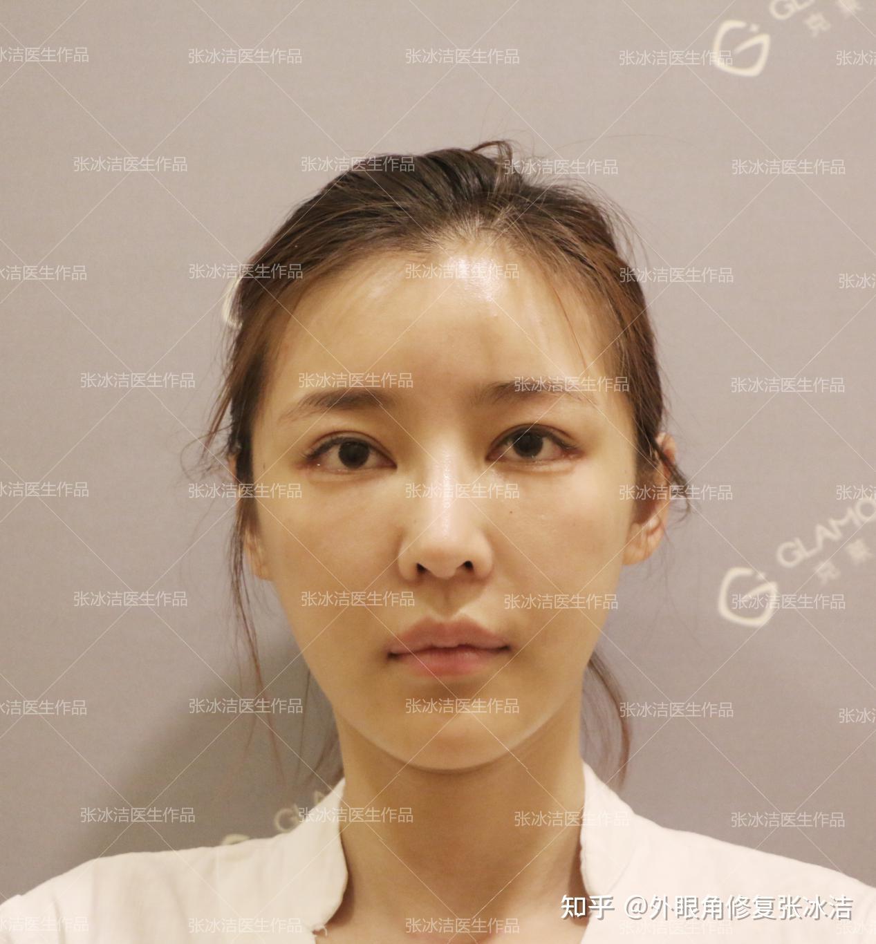 张冰洁眼睑下至案例丨外眼角开太大露红睫毛缺失修复下睑下至疤痕修复