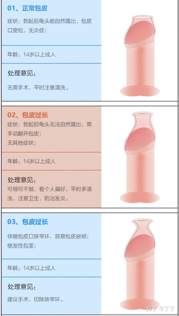 包皮有裂口 有一圈白色像皮筋勒着是的 包皮口有一圈很紧的白圈 二安网