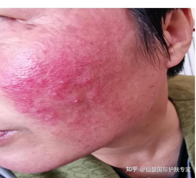 婆婆的脸最早因为过敏,使用激素类药物,对激素类药物也没有正确的认识