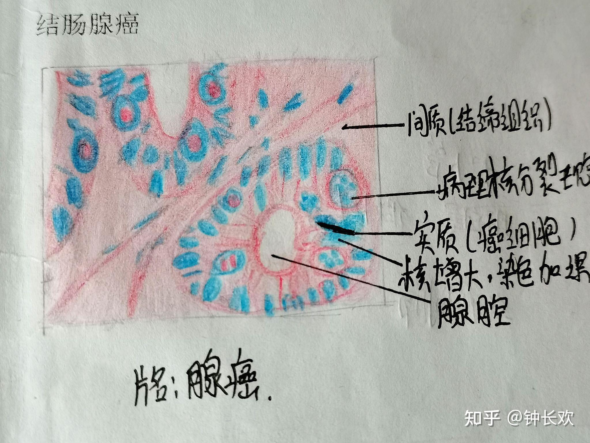 病理学红蓝铅笔绘图