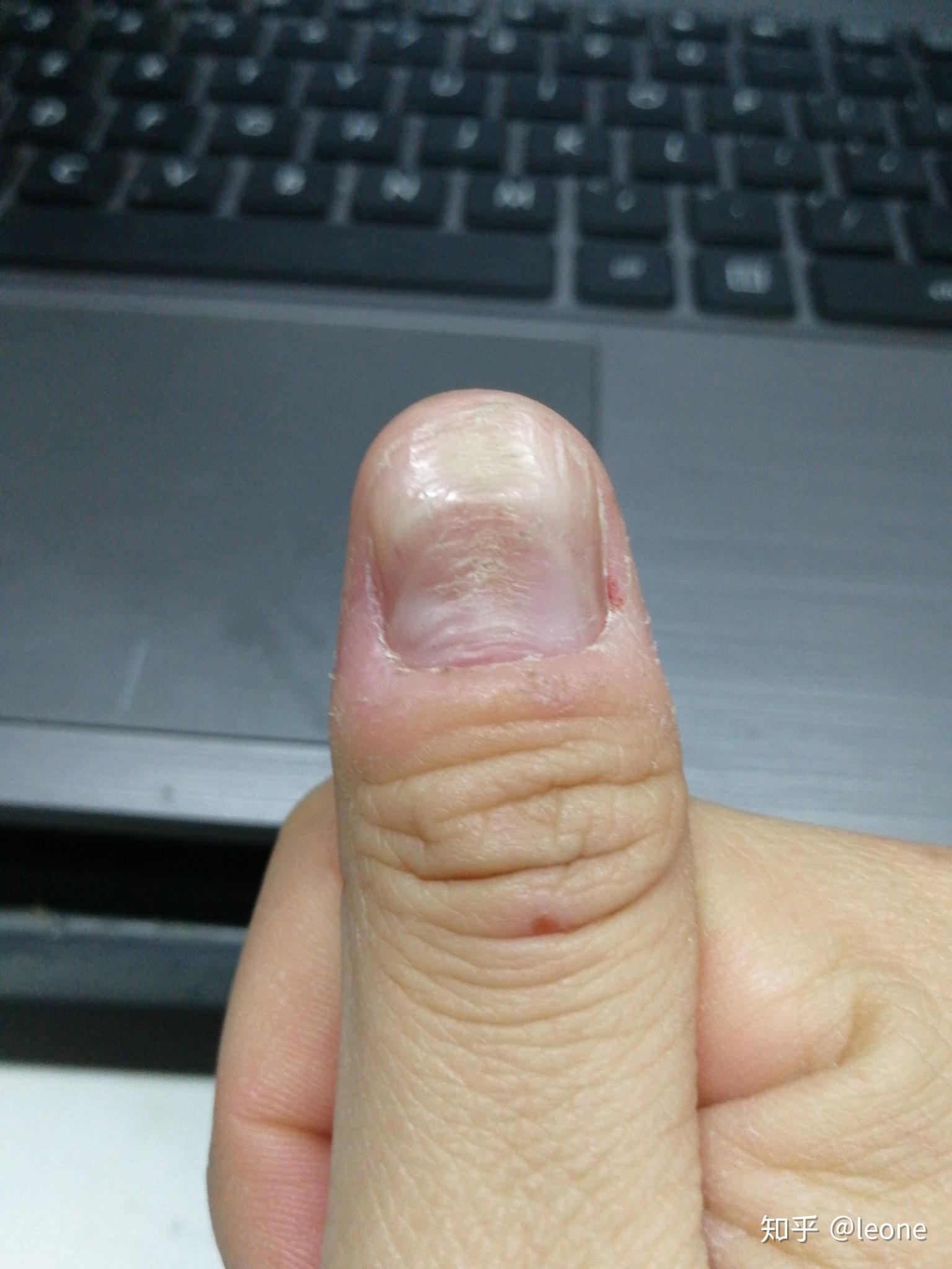 大拇指指甲凹凸不平,有凸起的横纹和凹陷,很多年了也没有其它问题,去