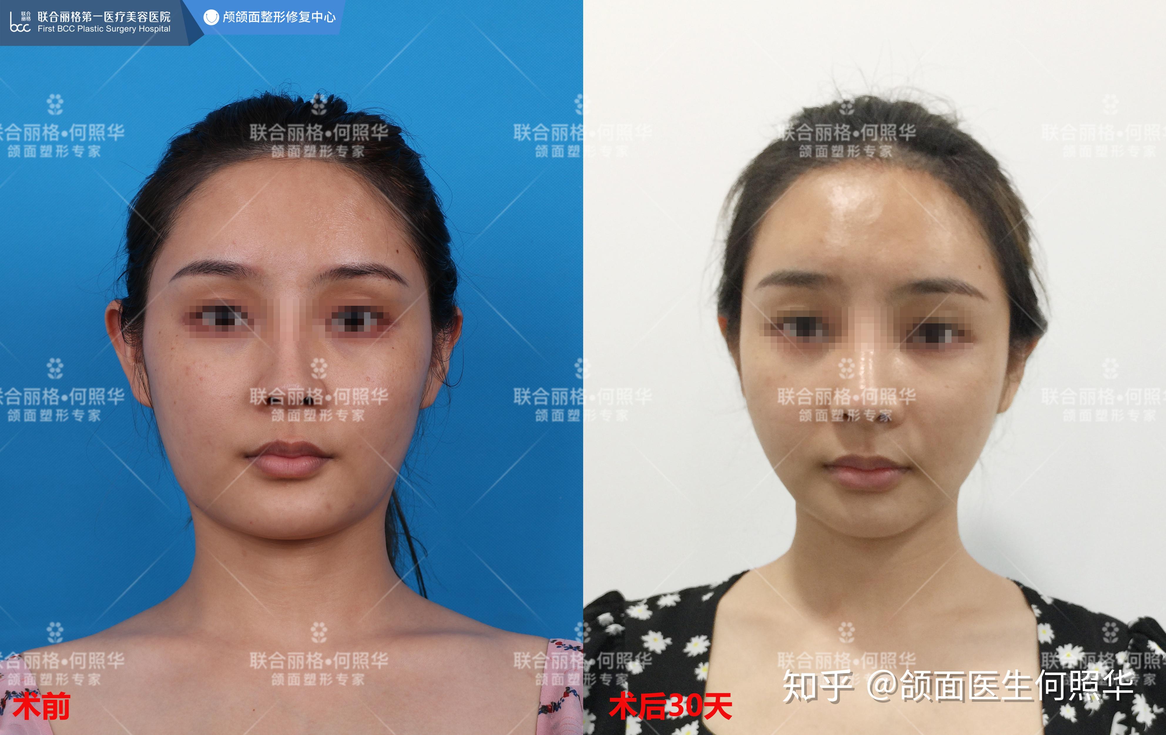 改脸型下颌角手术前后对比【卢丙仑教授手术案例】-搜狐大视野-搜狐新闻