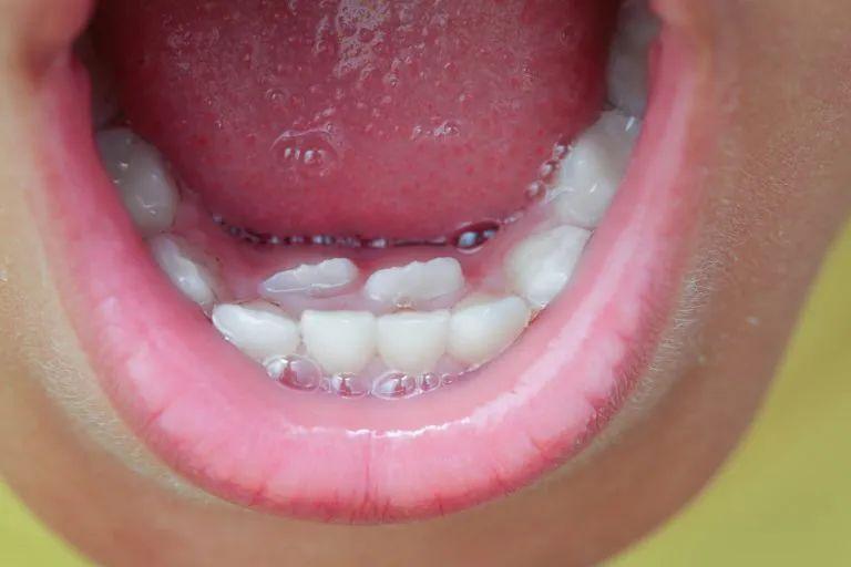 孩子出现双排牙,如果不注意恰当地纠正,会有以下危害:1,影响牙齿排列