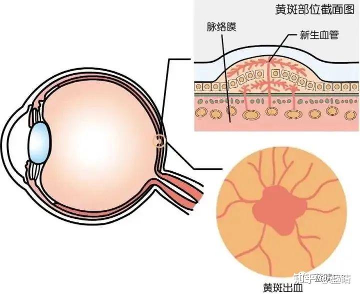 黄斑出血,脉络膜新生血管02视网膜裂孔,脱离01眼睛也一样,随着近视