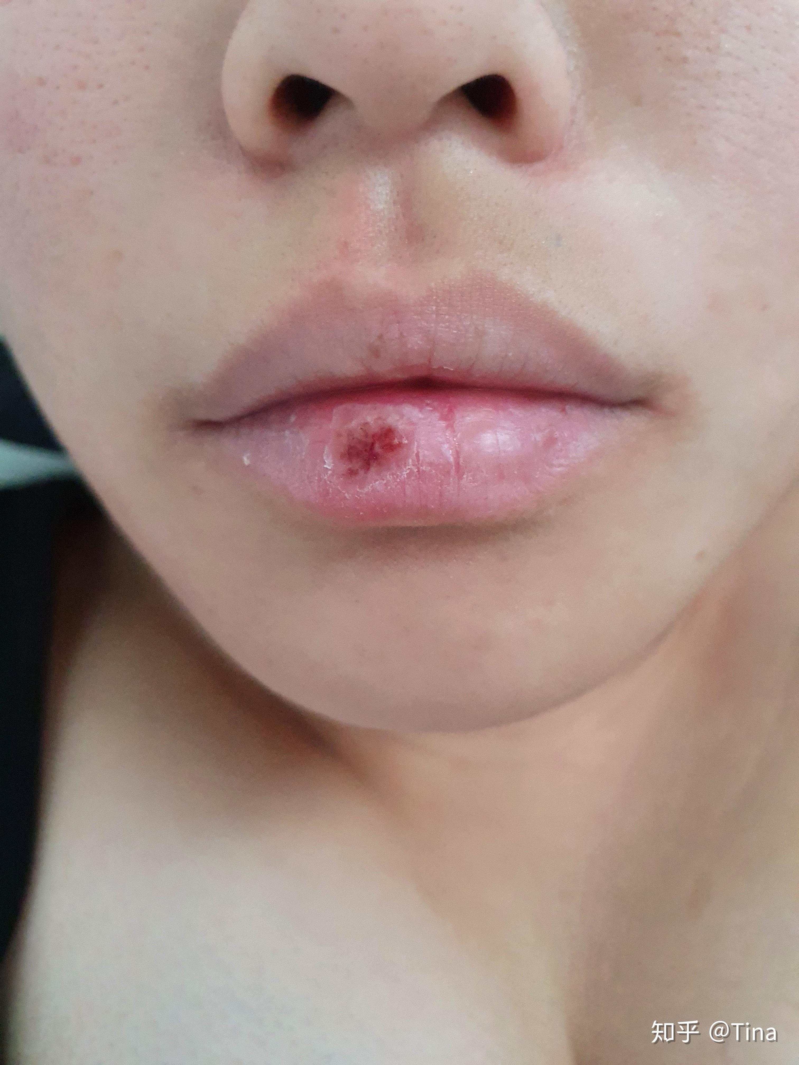 嘴唇上被咬到蚊子包是一种怎样的体验