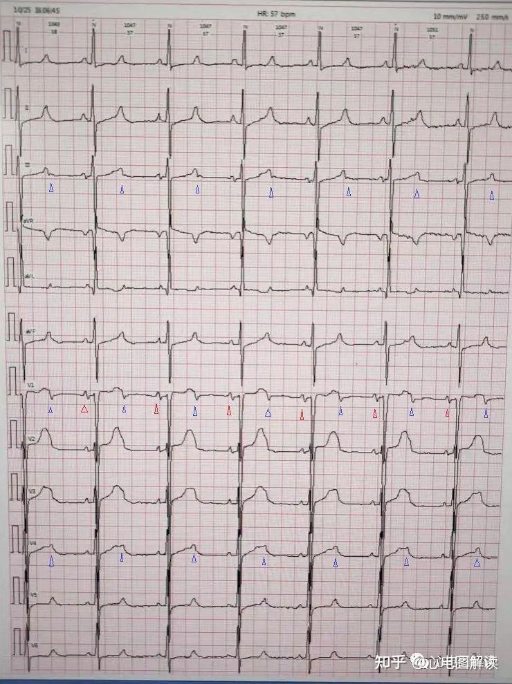 交界性心电图图片