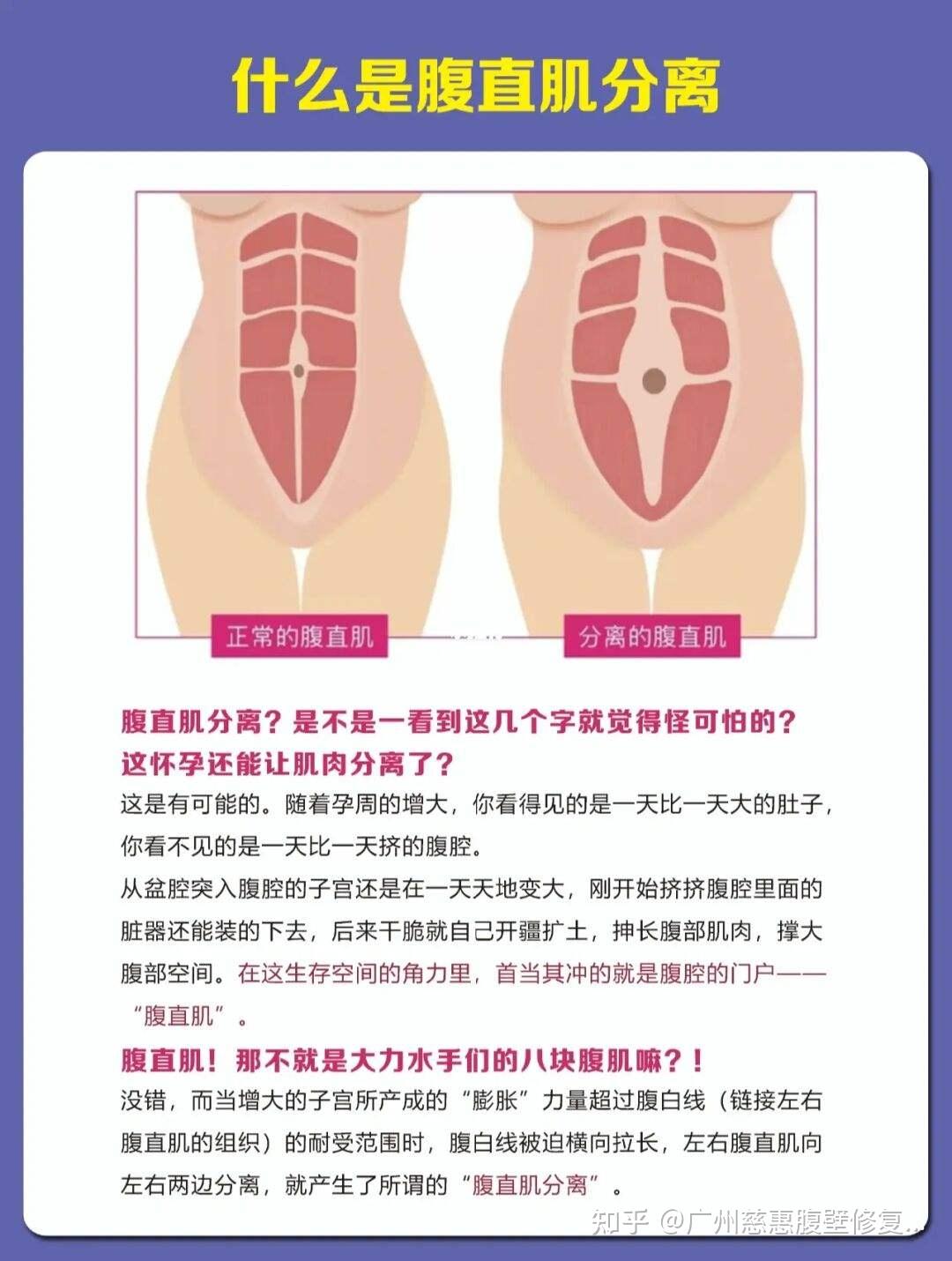 腹壁拉皮专家张斌解答产后肚皮松弛下垂靠运动能解决吗