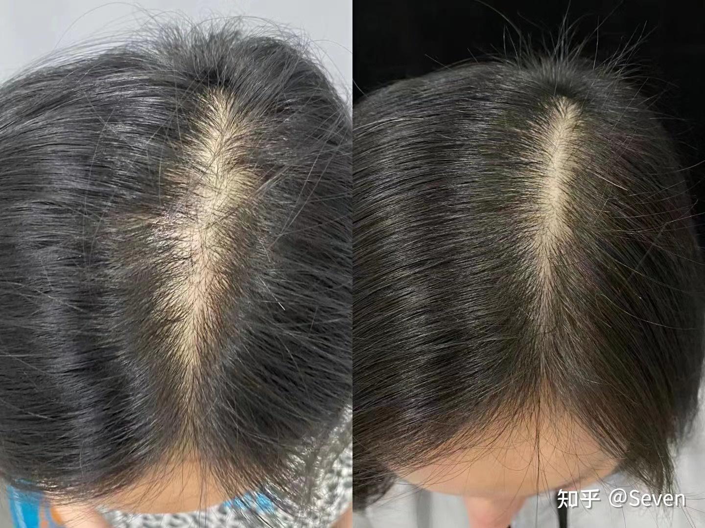 如何拯救脱发星人71下