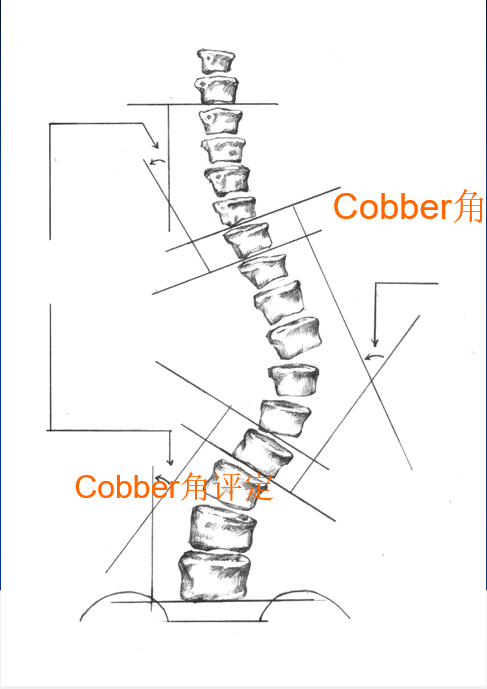 cobb角测量图解图片