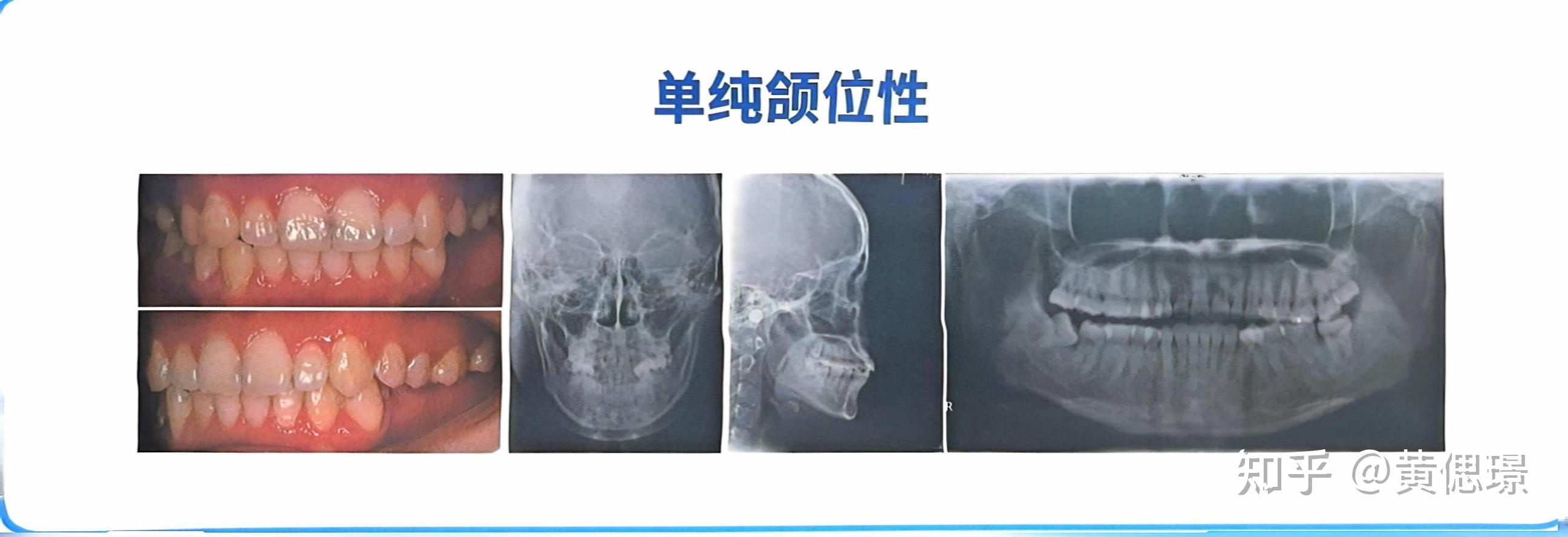 正畸诊断沈刚分类之偏颌 - 知乎
