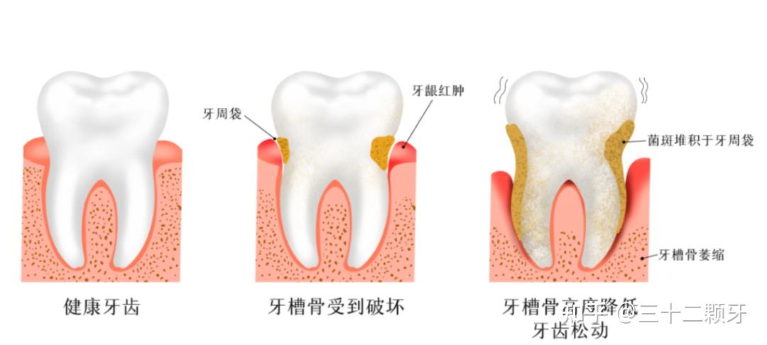 牙周炎?毁掉一口牙? - 知乎