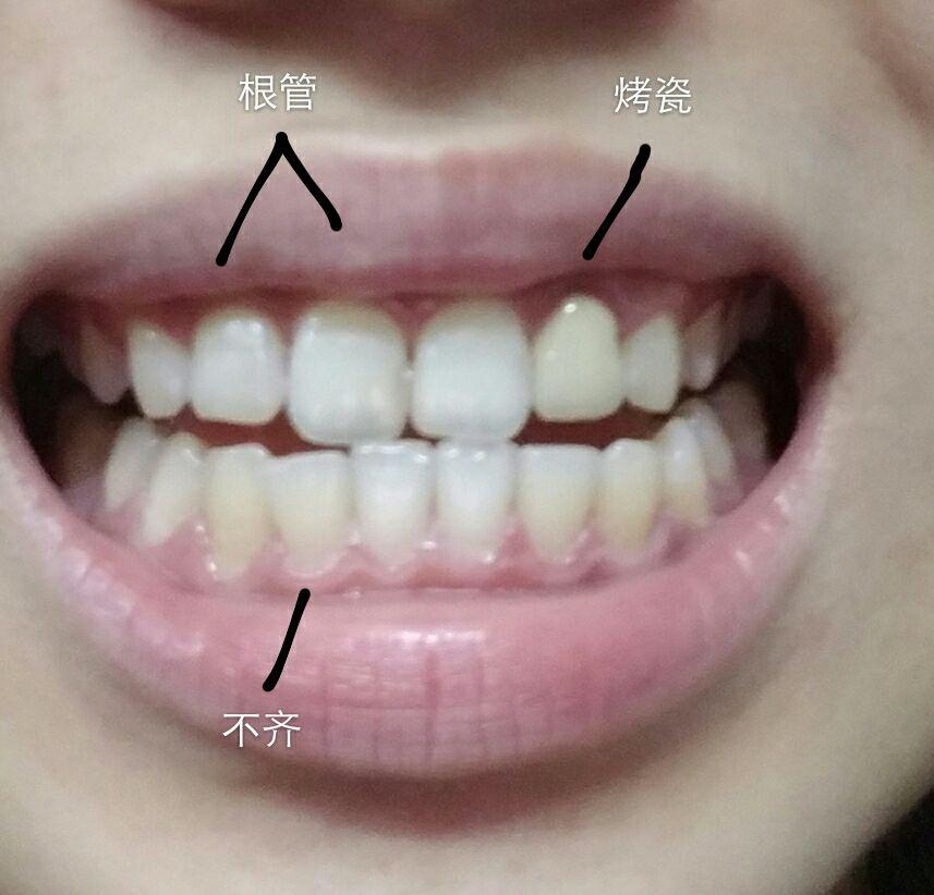 21岁门牙有两颗做过根管治疗还没戴牙套一颗做了很