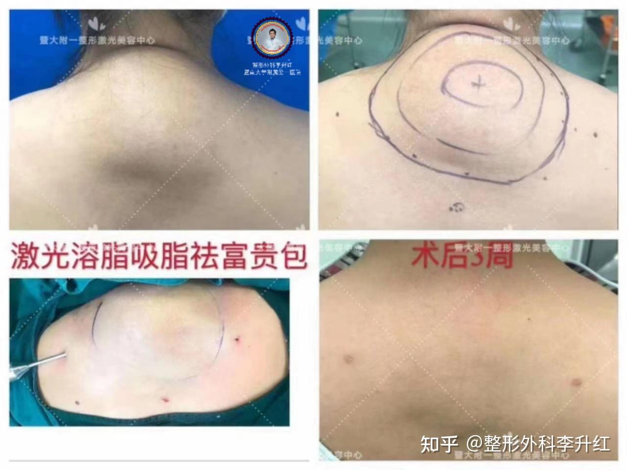 大家知道这个鼓包叫什么吗
