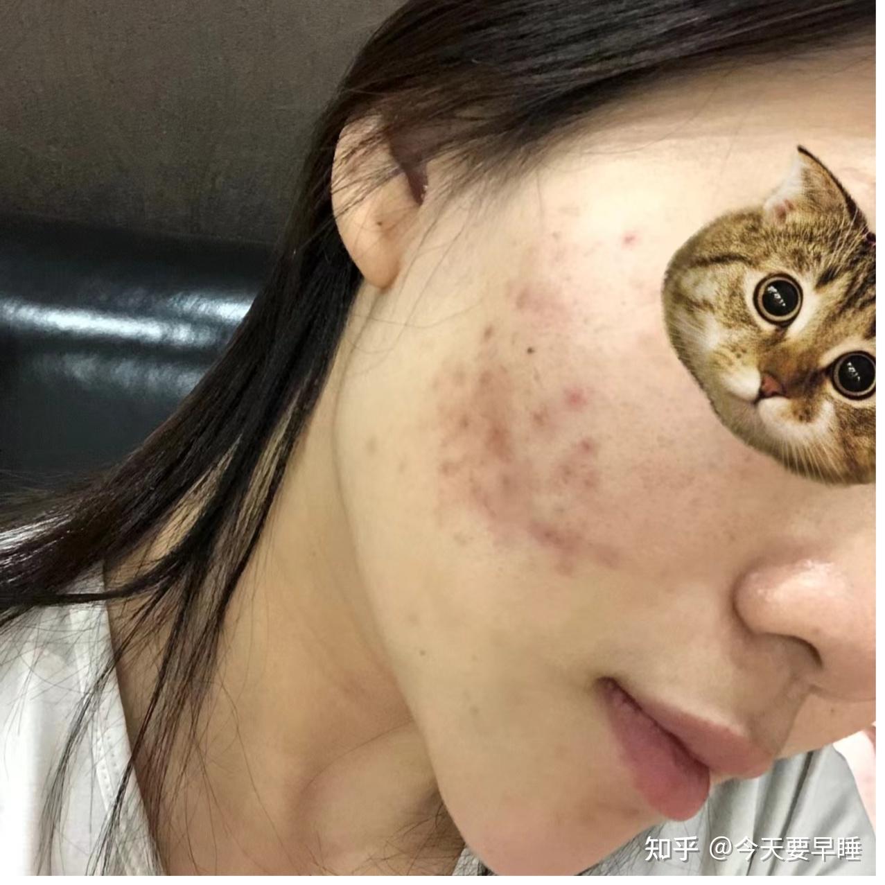 怎么淡化痘印跪求良心推荐