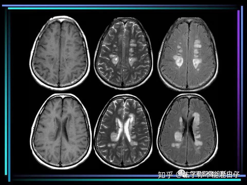 老人脑白质病变图片