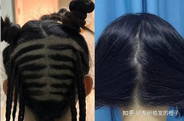 植发干货总结，新手做植发有哪些注意事项？技术、医院、医生怎么选？看完立省几千！ - 知乎