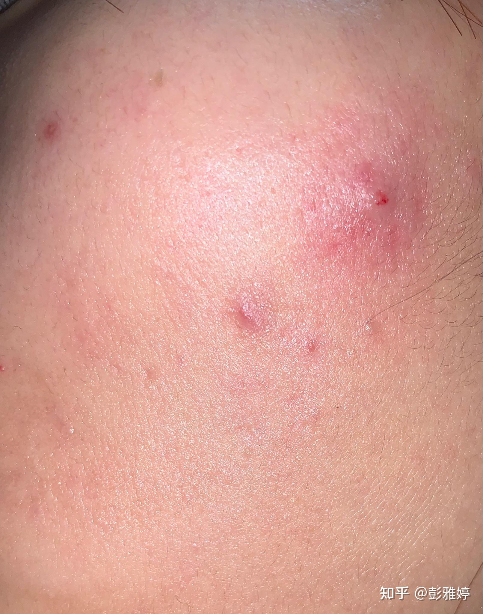 脸上有硬疙瘩不多感觉在皮肤下面不痛也不痒该怎么解决