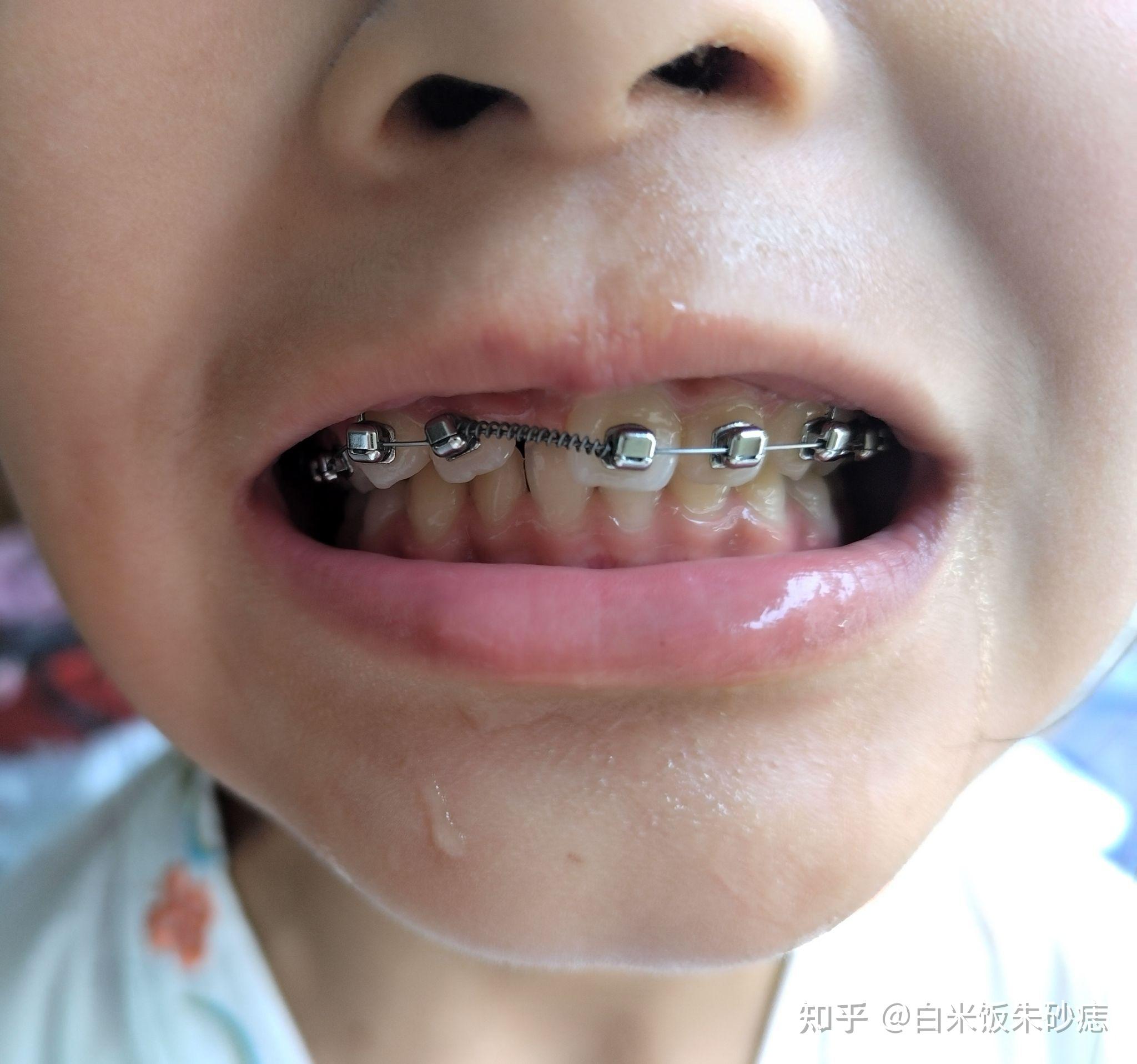 十岁孩子矫牙记（上门牙倒置） - 知乎
