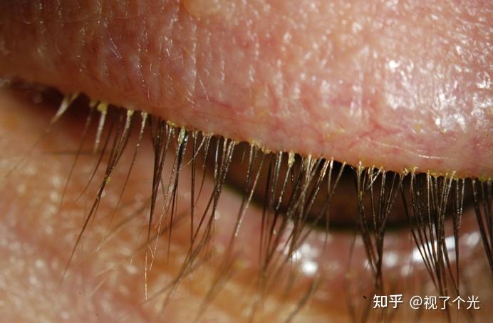 眼睫毛上真的会长螨虫吗?