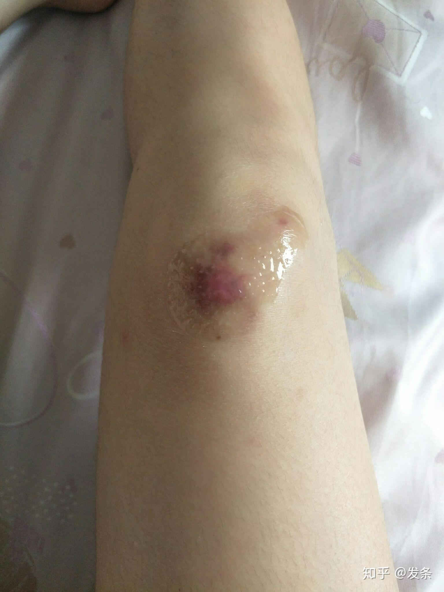 女生骑车摔伤腿的照片图片