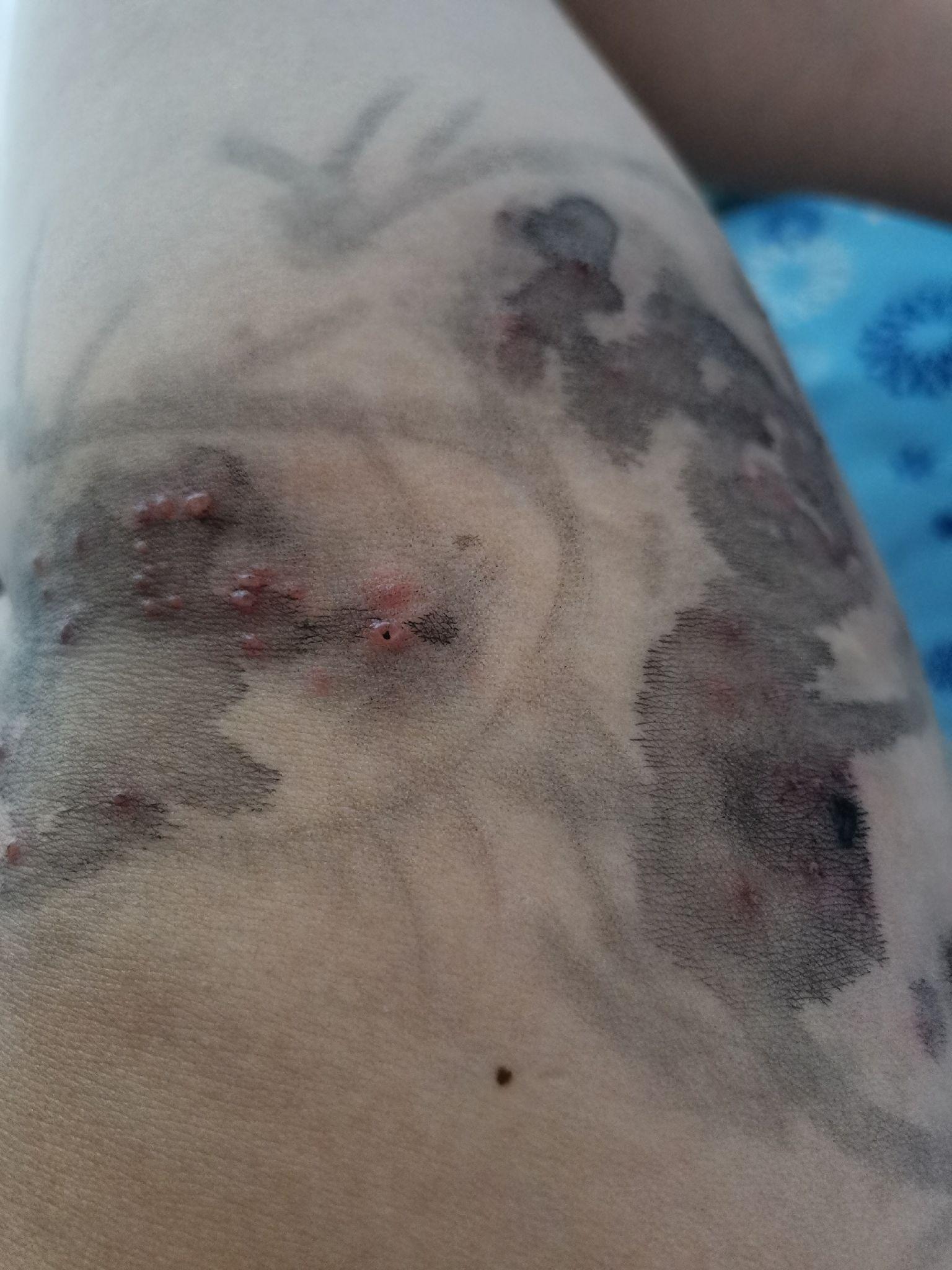 毕竟年纪大看得多,和奶奶视频她一看就说是龙须疮也就是带状疱疹,她很