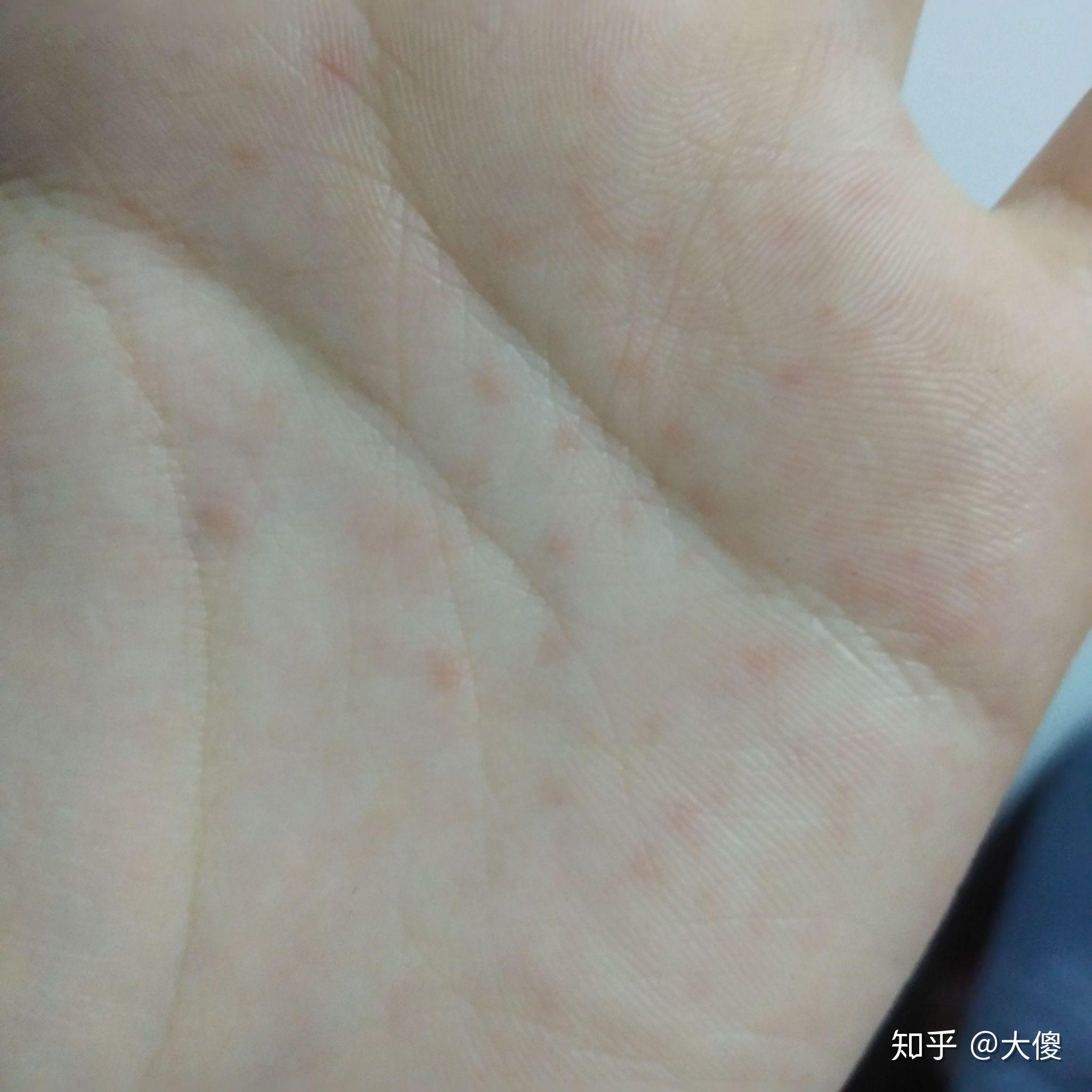 手掌心肉里面有红点点怎么办我查百度居然说是艾滋病好可怕啊5555