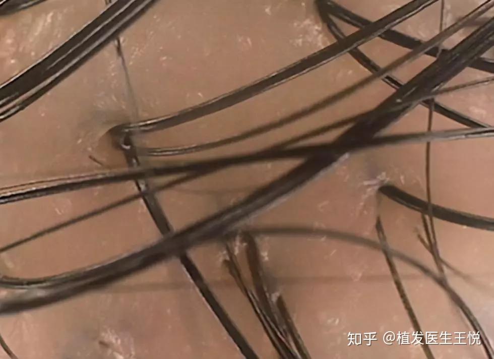 防脱发你需要提前知道自己的头皮状态