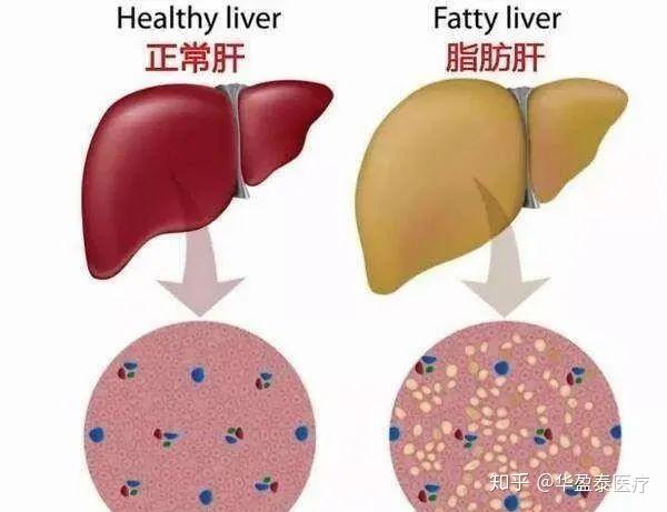 4个原因可以导致脂肪肝 哪些方法来确诊 这样做可以逆转 知乎