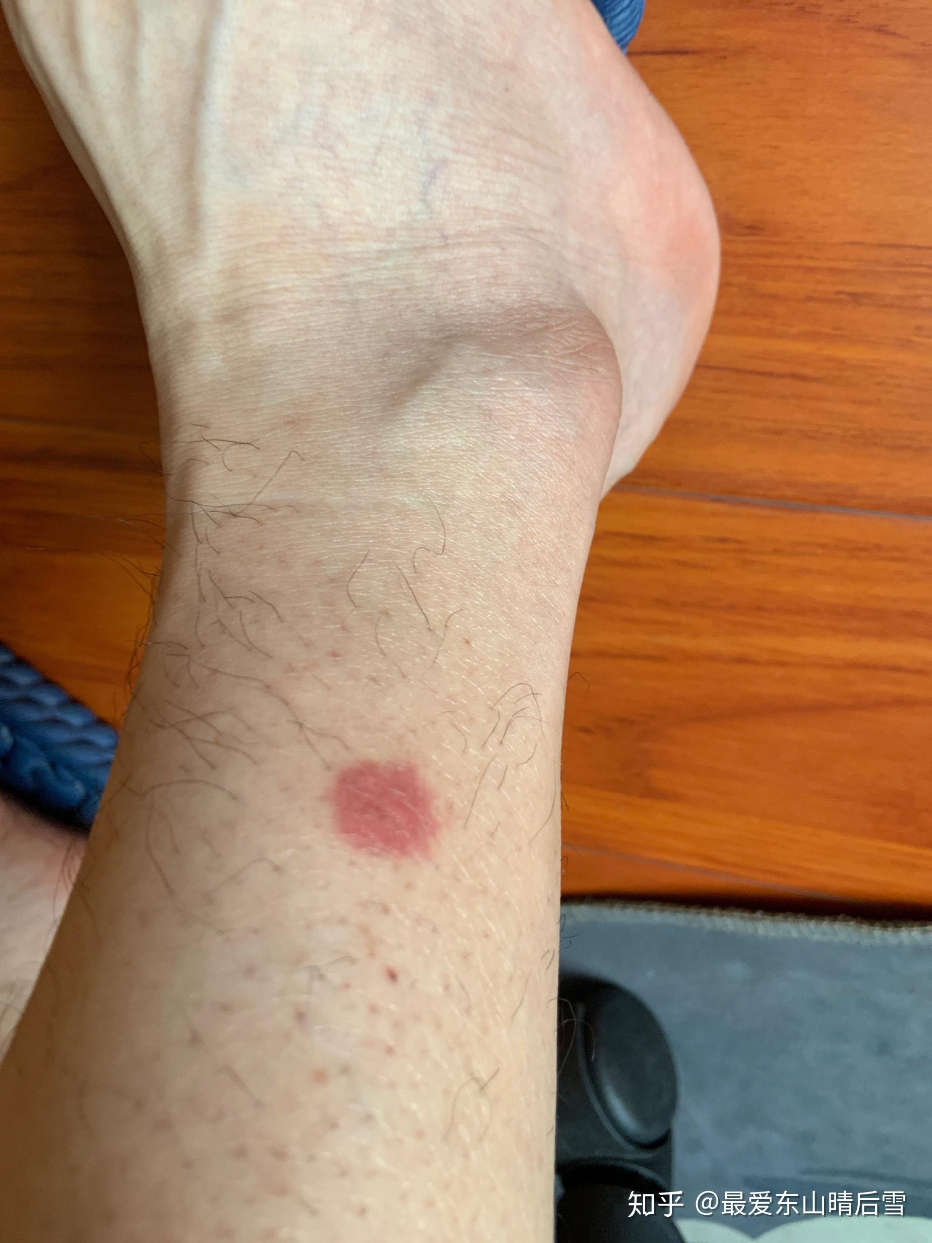 跳蚤咬了怎么办