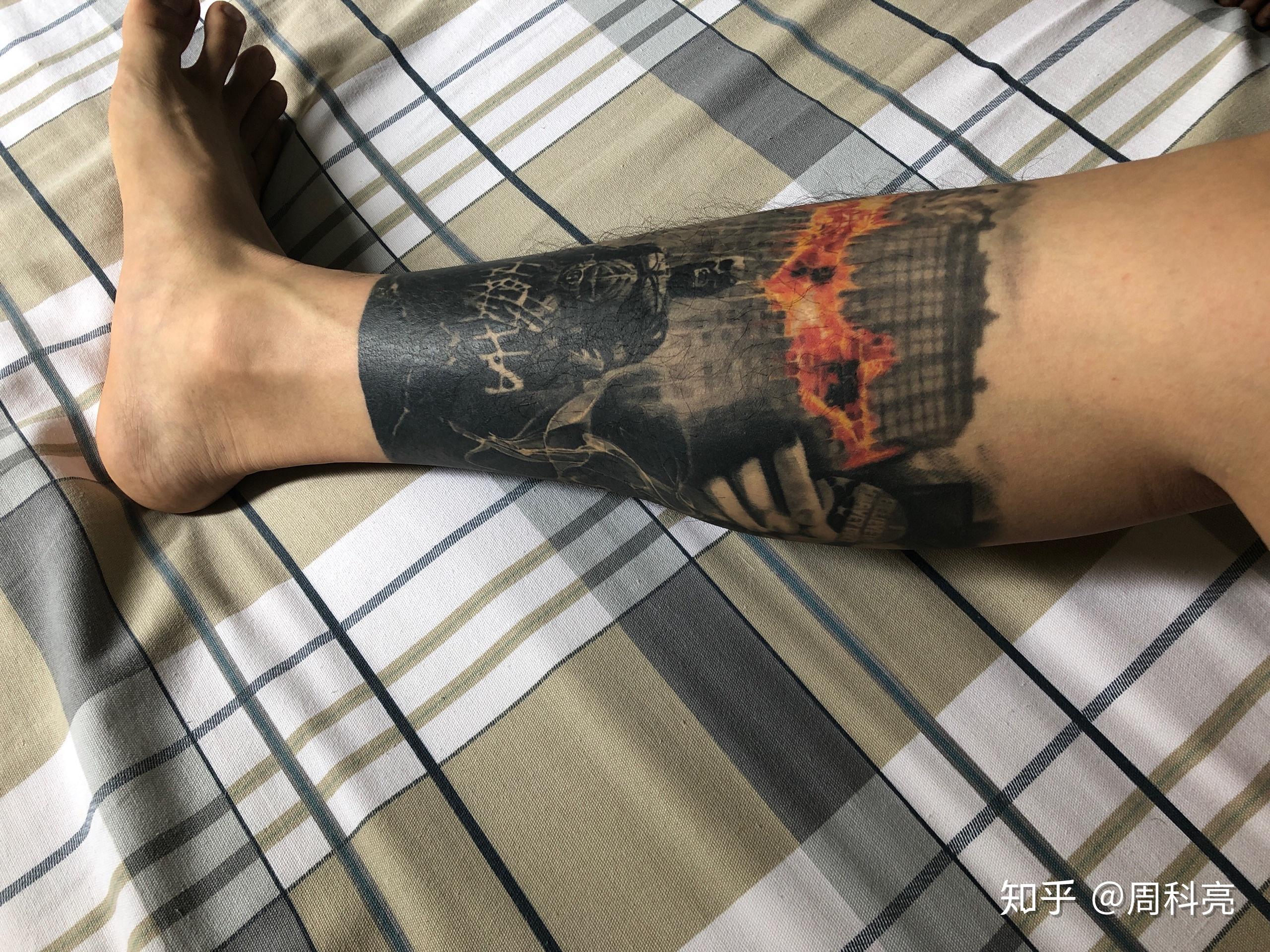 有没有什么办法可以加速纹身褪色?