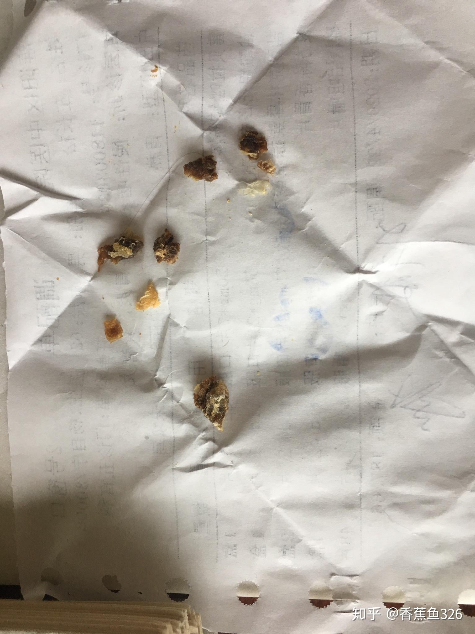 耳屎最大能有多大