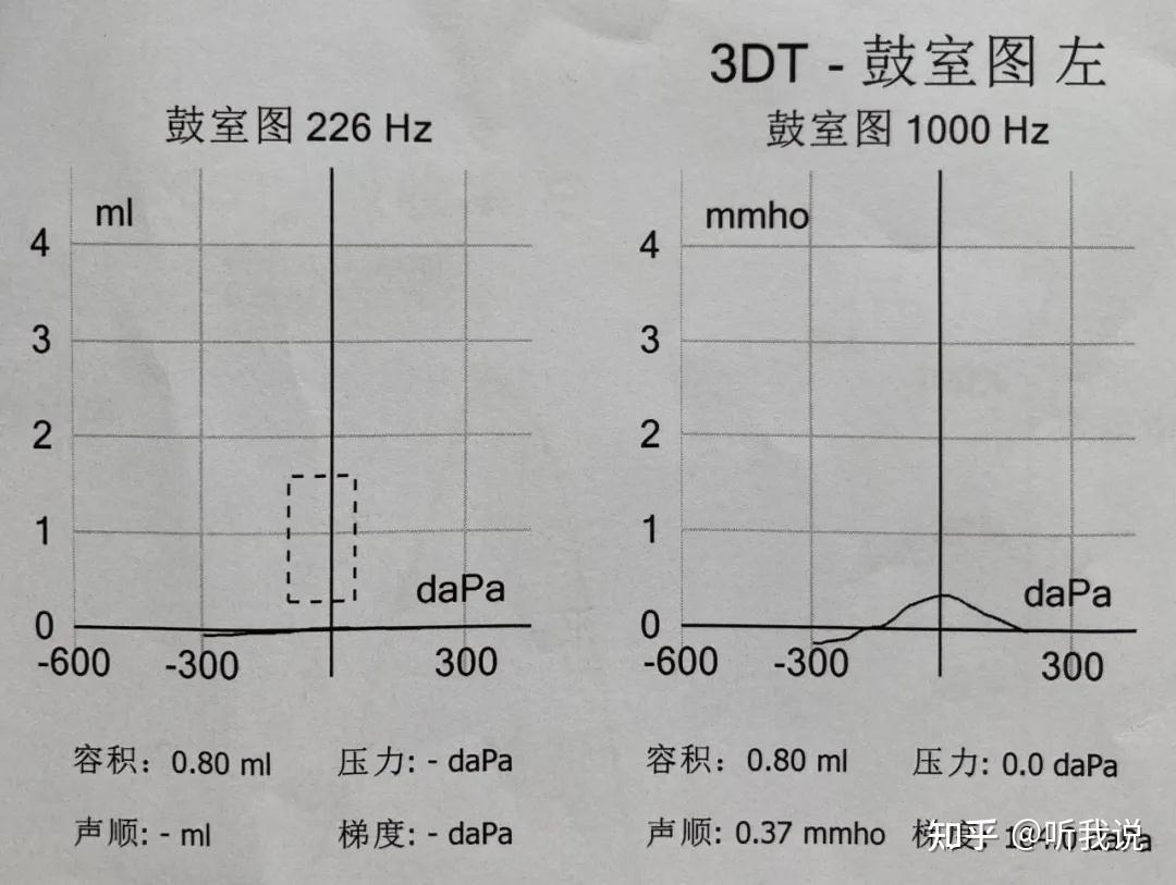 声导抗耳鸣匹配:左耳,8k hz,75 db(啭音) 右耳,8k hz,90 db(啭音)左耳