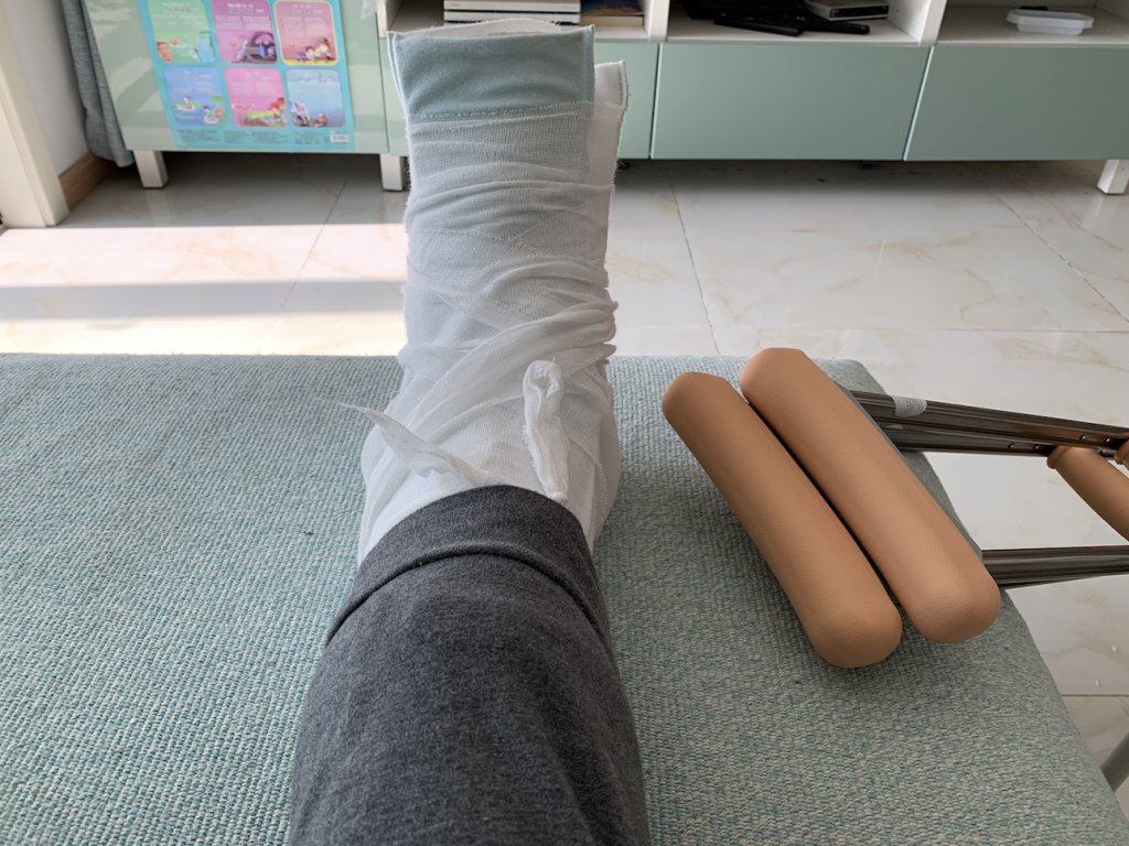 石膏要一个月复查的时候才能拆掉,到时候看看关节的活动度如何.