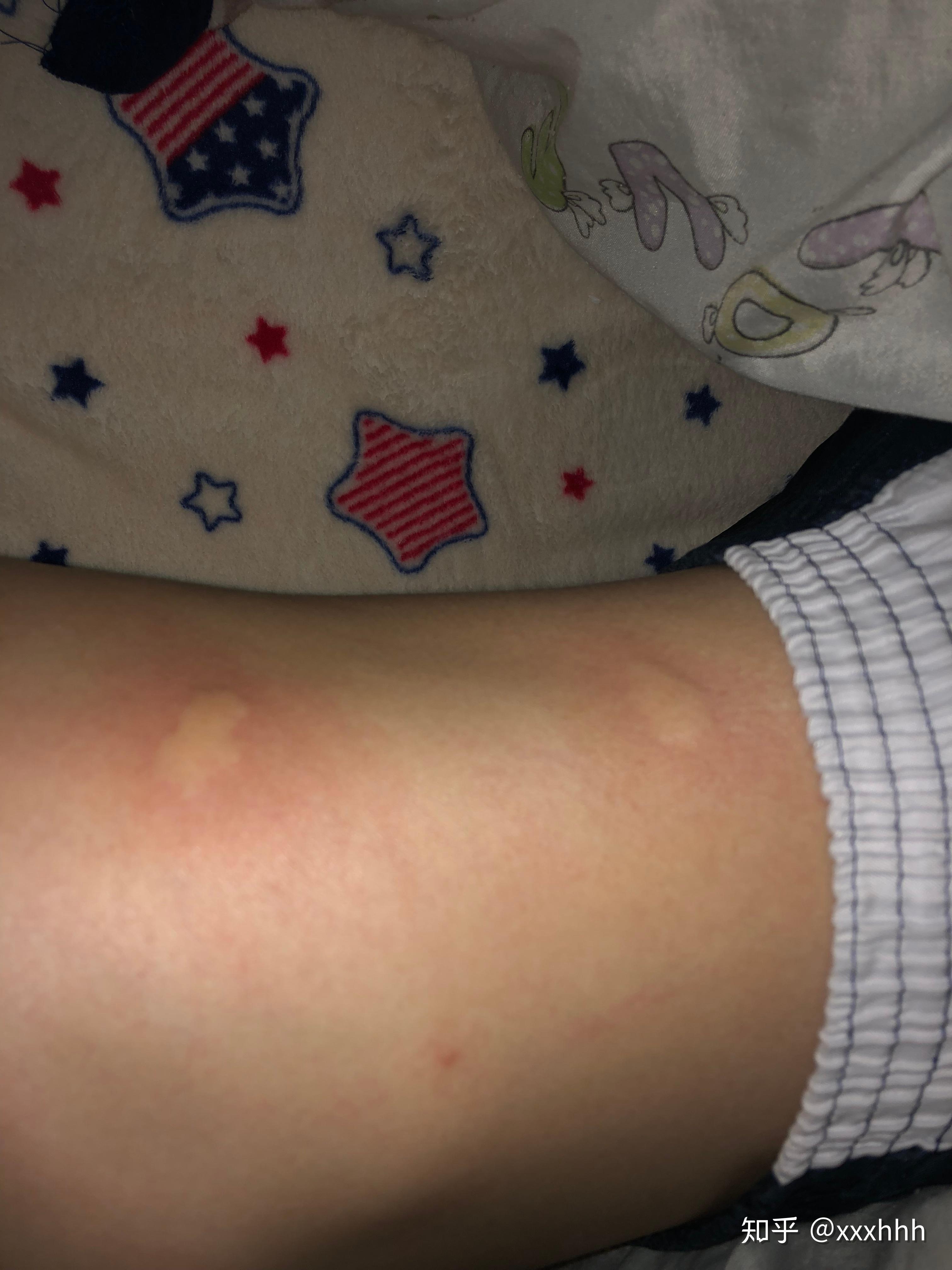 提问,皮肤痒,起了一个个风团块,有什么建议吗? - 知乎