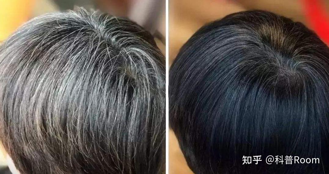 黑发真的能变成白发吗?一夜白头的真相揭开谜团 - 知乎