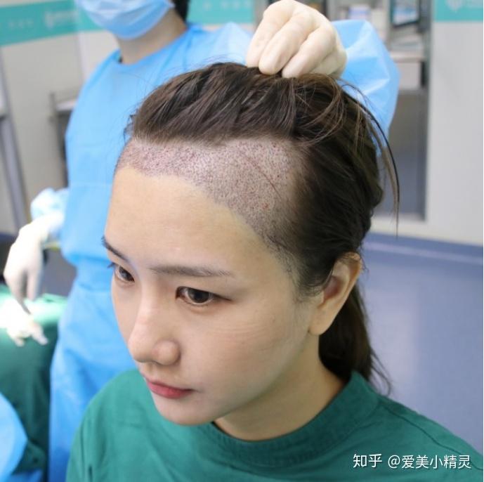 这种的发际线后移m型头发是否适合植发呢