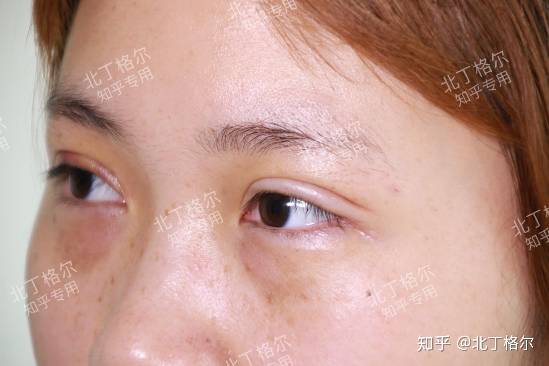 眼皮厚成这样还能拯救么? - 知乎