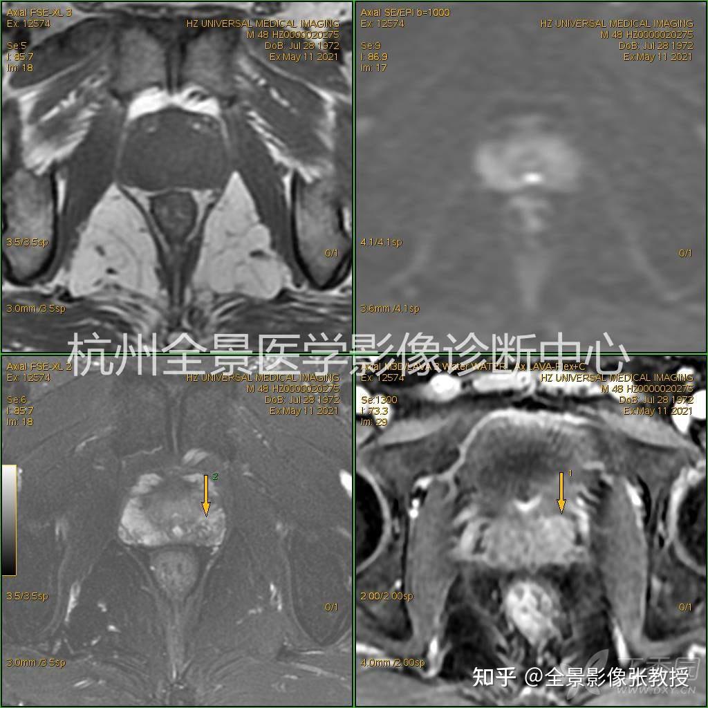 案例分享|前列腺炎?前列腺癌?(病理结果已公布,见评论区) - 知乎
