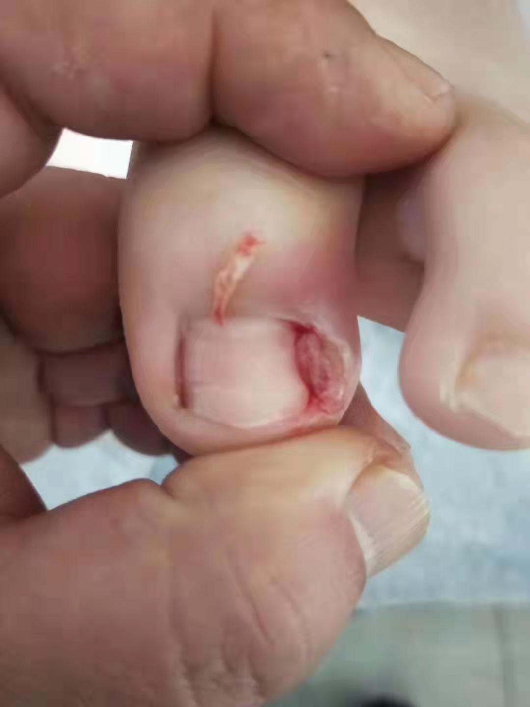 为什么我不建议你得了甲沟炎后选择拔甲?