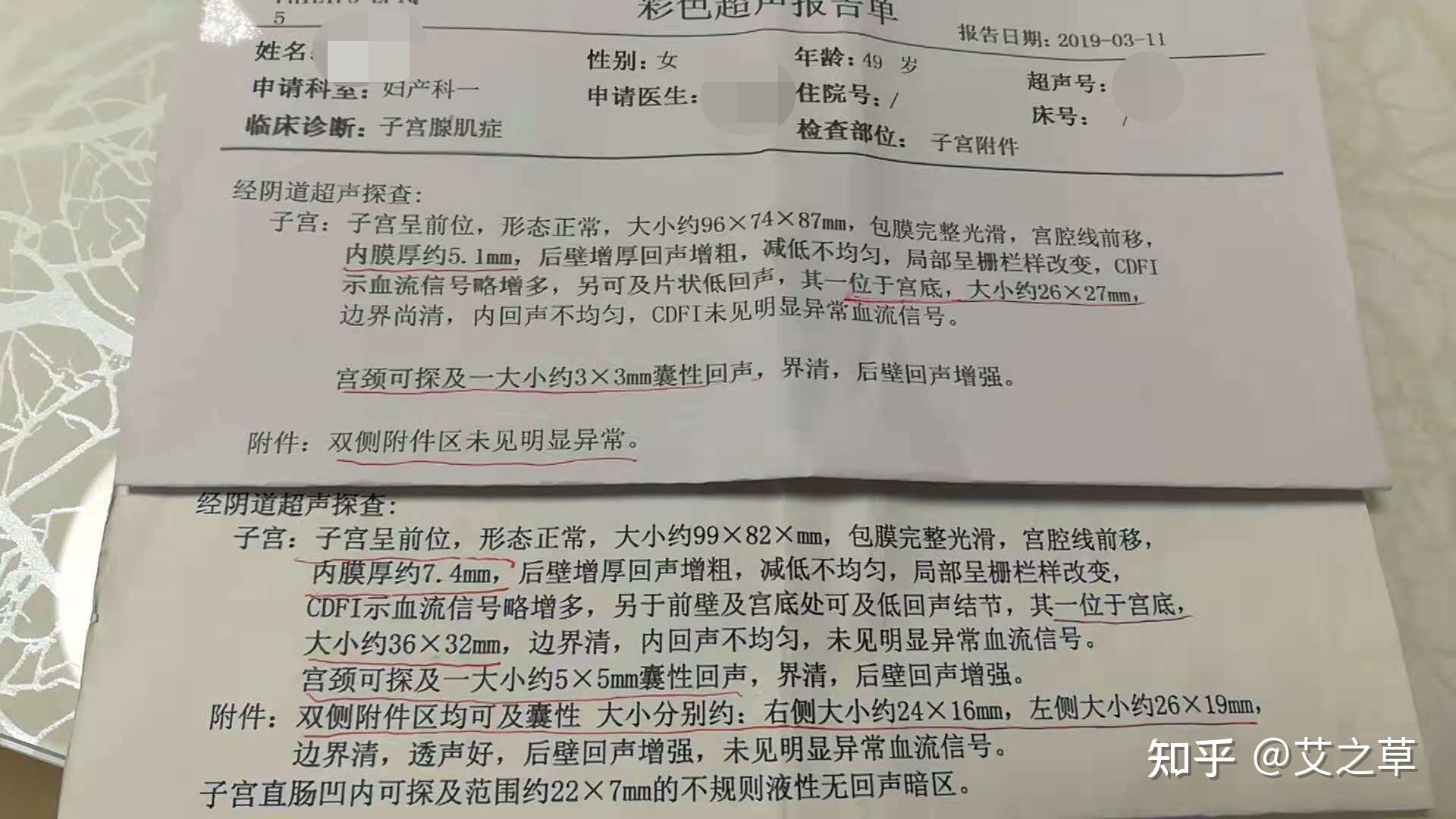 艾灸灸好了我的子宫腺肌症