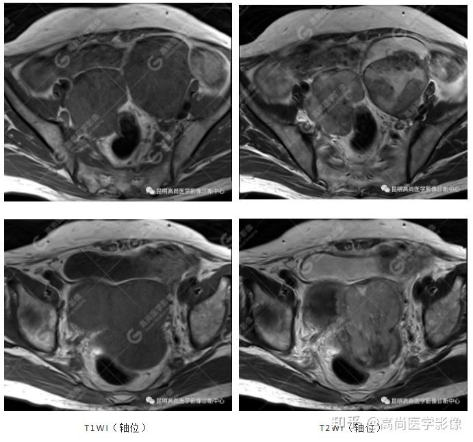 宫颈癌的ct影像表现图片