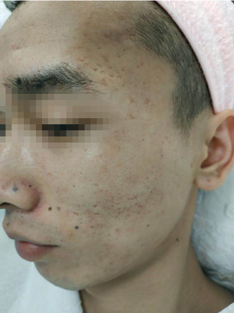 男生痘印怎么去除