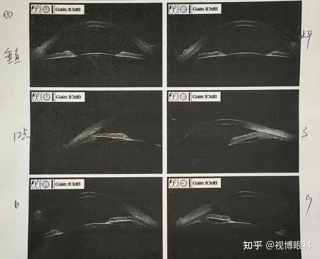 360小梁切开术图片