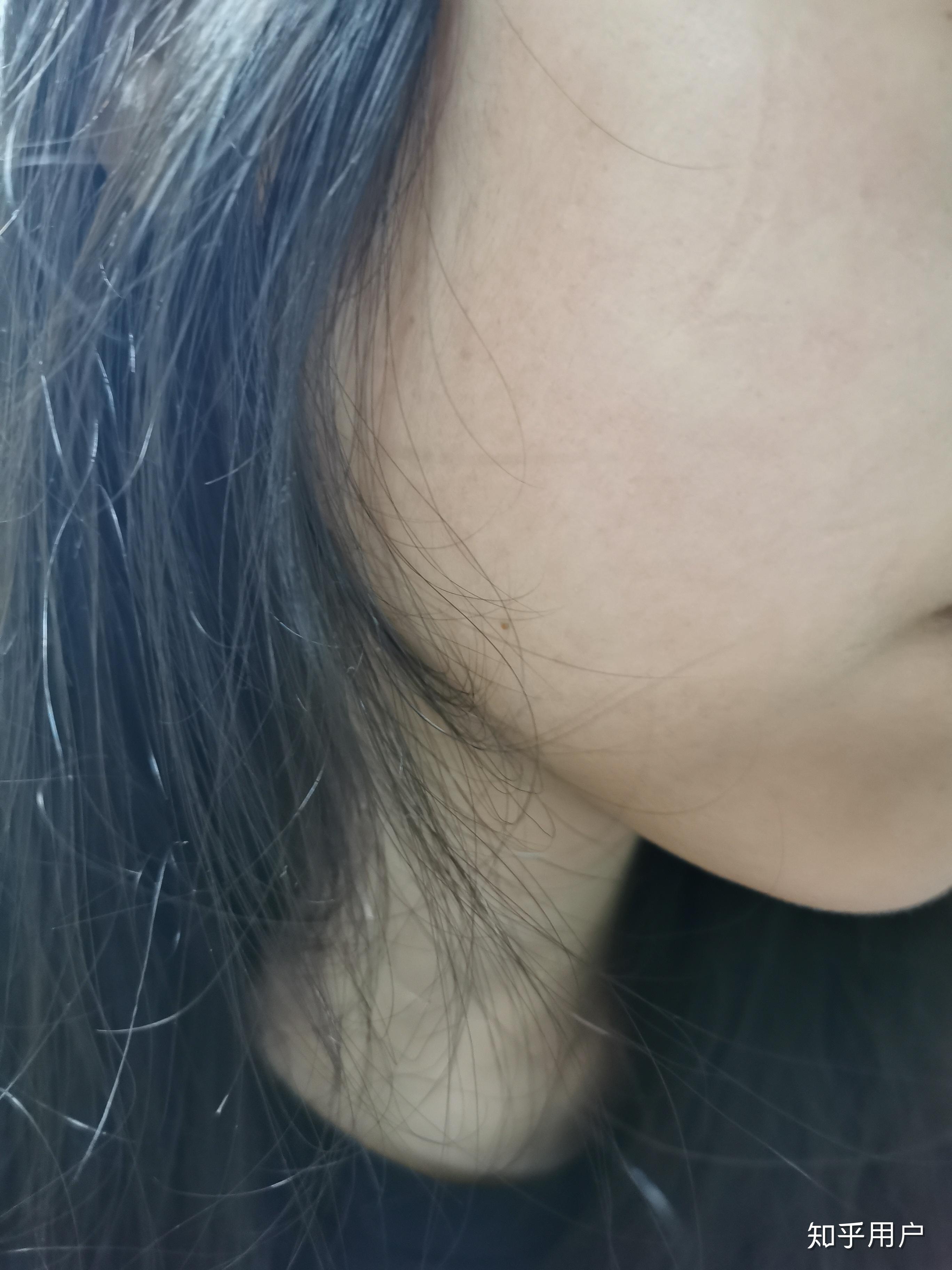 脸部鸡皮肤发红能根除吗(脸上鸡皮肤红色素怎么消除)