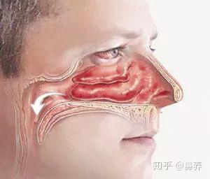 什么是进行性鼻塞 v2-985d3df6c2e92cbf65b22b7864710904_b.jpg