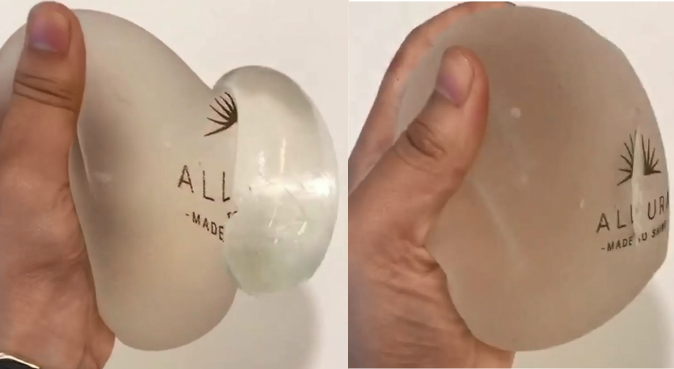 9 人 赞同了该文章 其实隆胸的假体品牌有很多,一一列举的话,实在