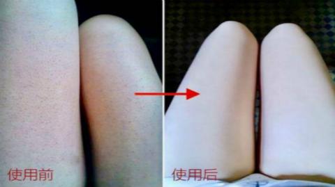 怎么样让腿的鸡皮疙瘩去掉(怎么样让腿的鸡皮疙瘩去掉不留疤)