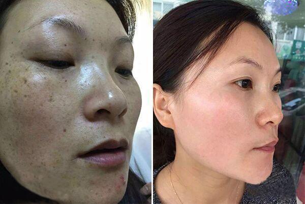 哪种祛斑产品比较靠谱? - 知乎