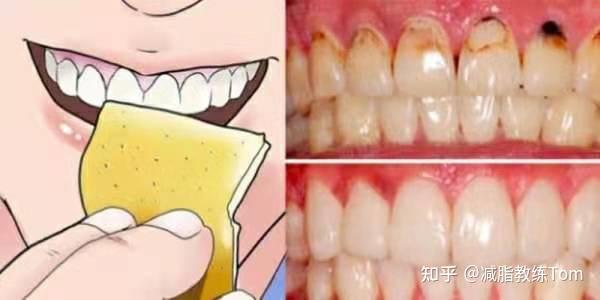 很遗憾的告诉你,牙齿天生就是黄的,真正健康的牙齿就是微微发黄的颜色